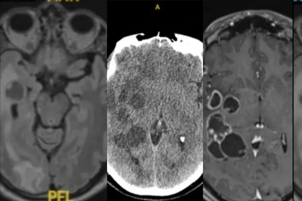 ಸ್ಪೇನ್ :ತಲೆನೋವು ಎನ್ನುತ್ತಿದ್ದ ವ್ಯಕ್ತಿಯ MRI ಸ್ಕ್ಯಾನ್​ ಕಂಡು ದಂಗಾದ ವೈದ್ಯರು​! ರಿಪೋರ್ಟ್​ನಲ್ಲಿ ಗೊತ್ತಾಯ್ತು ಭಯಾನಕ ವಿಷಯ..!!